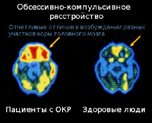 Результаты сканирования мозга пациентов с ОКР. 